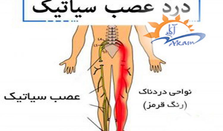 درد عصب سیاتیک